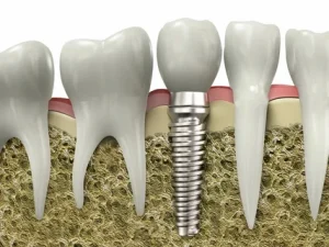 Diş İmplantı Avantajları